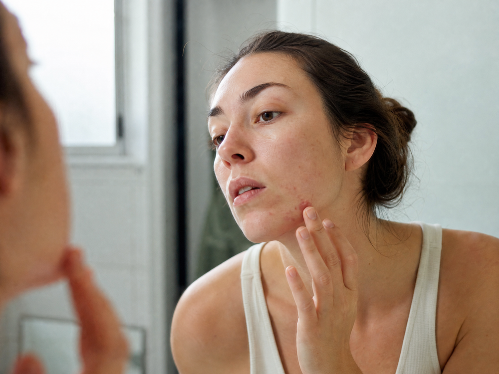 The gut and skin connection